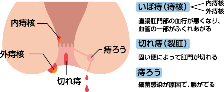 痔の種類