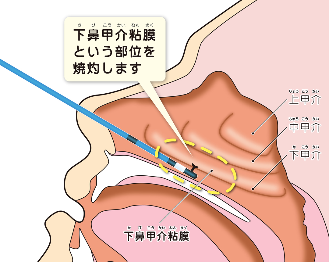 アルゴンプラズマ治療