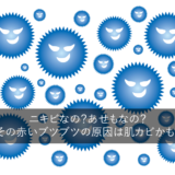 ニキビなの？あせもなの？その赤いブツブツの原因は肌カビかも！